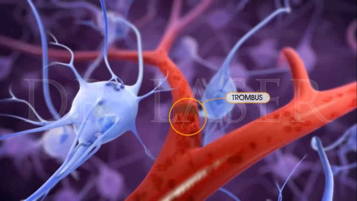 Trombus Menyumbat Darah Ke otak